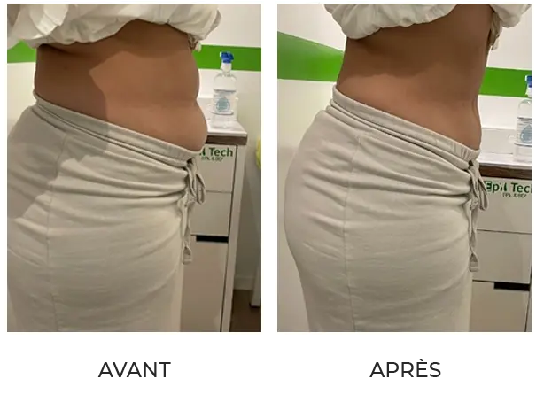 Résultat après 1 séance de cryolipolyse et 3 séances de drainage