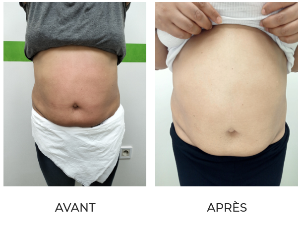Résultat après 2 cures minceur complètes