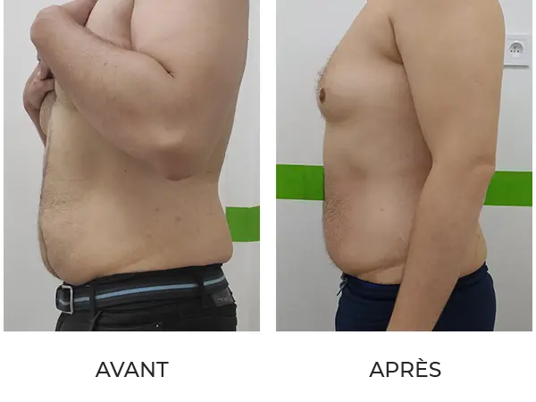 Résultat après une cure minceur complète