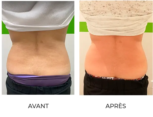 Résultat après 1 séance de cryolipolyse et 4 séances de drainage