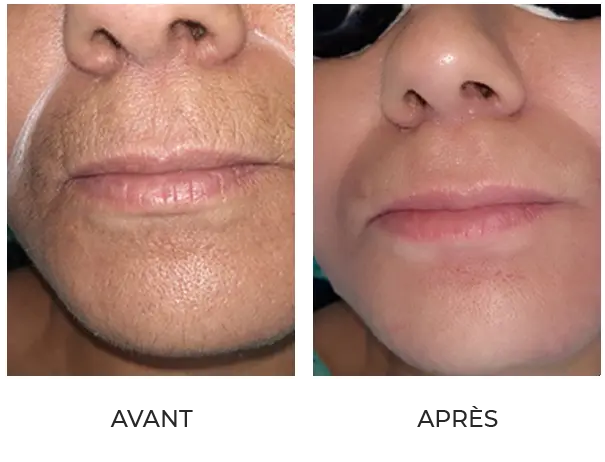 Résultat après 6 séances d'IPL