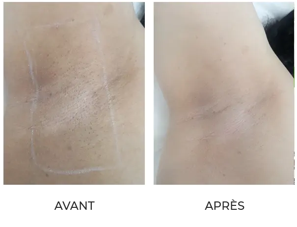 Résultat après 5 séances d'IPL