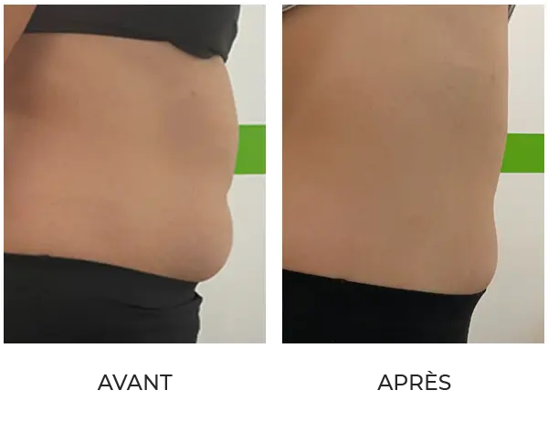 Résultat après 8 séances de lipocavitation