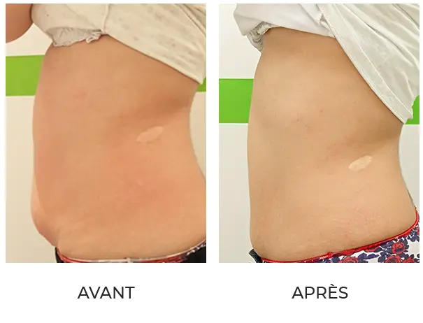 Résultat après 4 séances de lipocavitation