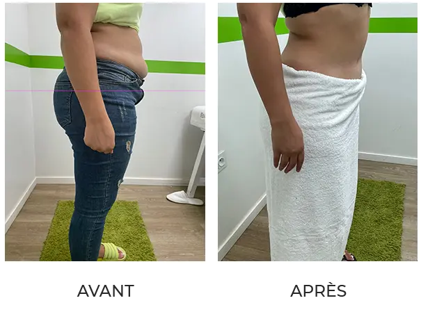 Résultat après 10 séances de lipocavitation