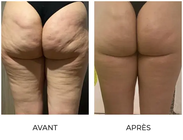 Résultat après 6 séances de Velashape