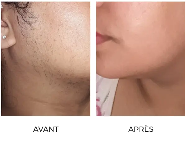 Résultat après 6 séances d'épilation définitive