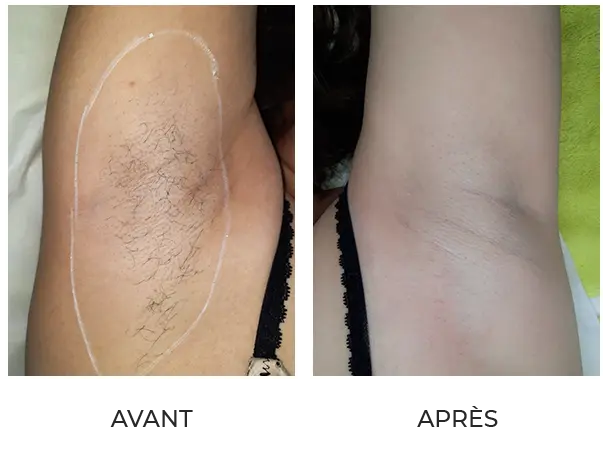 Résultat après 6 séances d'épilation définitive
