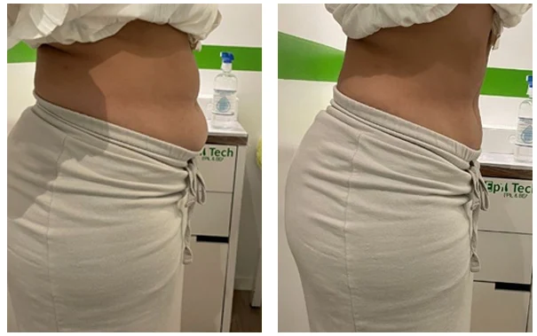 Avant / après chez EpilTech - Découvrez en image les résultats de nos client(e)s qui nous ont fait confiance !