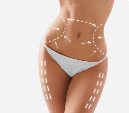 Cryolipolyse Treatment