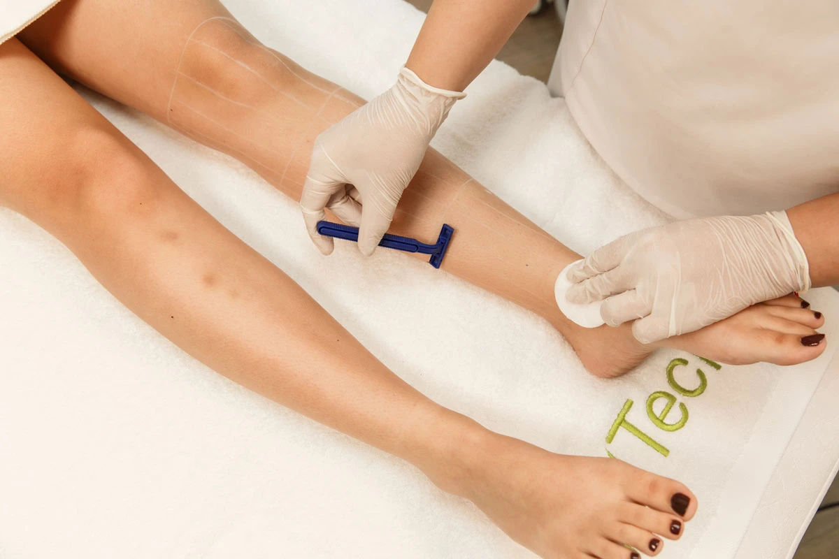 Recommandations pour l'épilation au laser